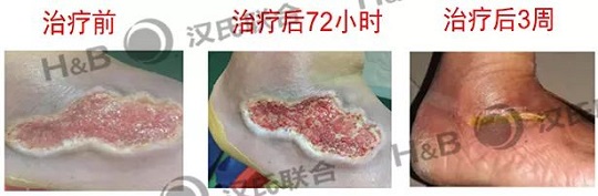 糖尿病足治疗